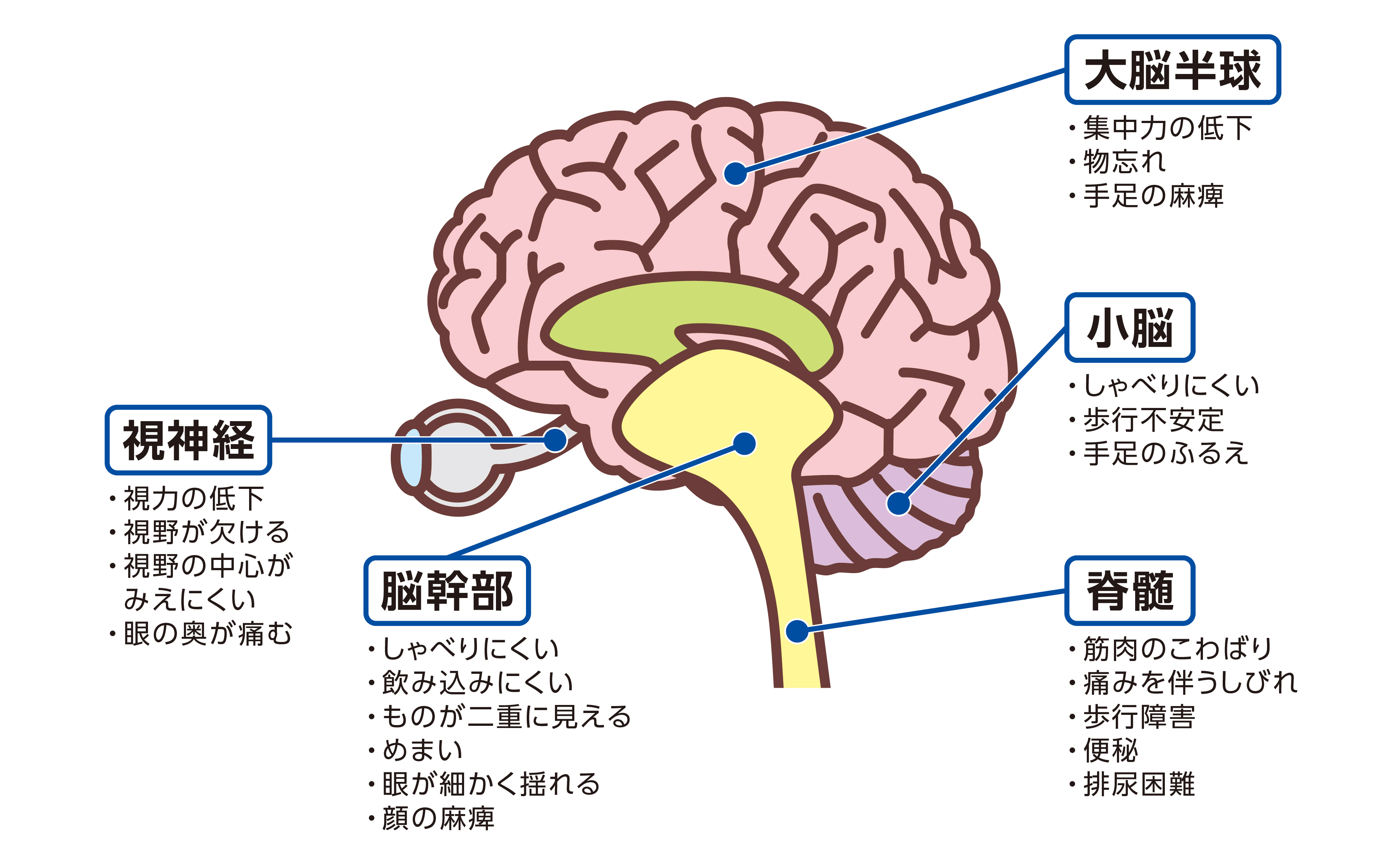 多発性硬化症（MS）にあらわれる脳の部位ごとの主な症状：視神経、脳幹部、大脳半球、小脳、脊髄
